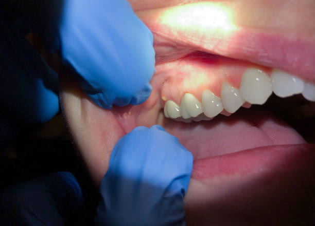 Tooth Infection Emergency Dentist in MS